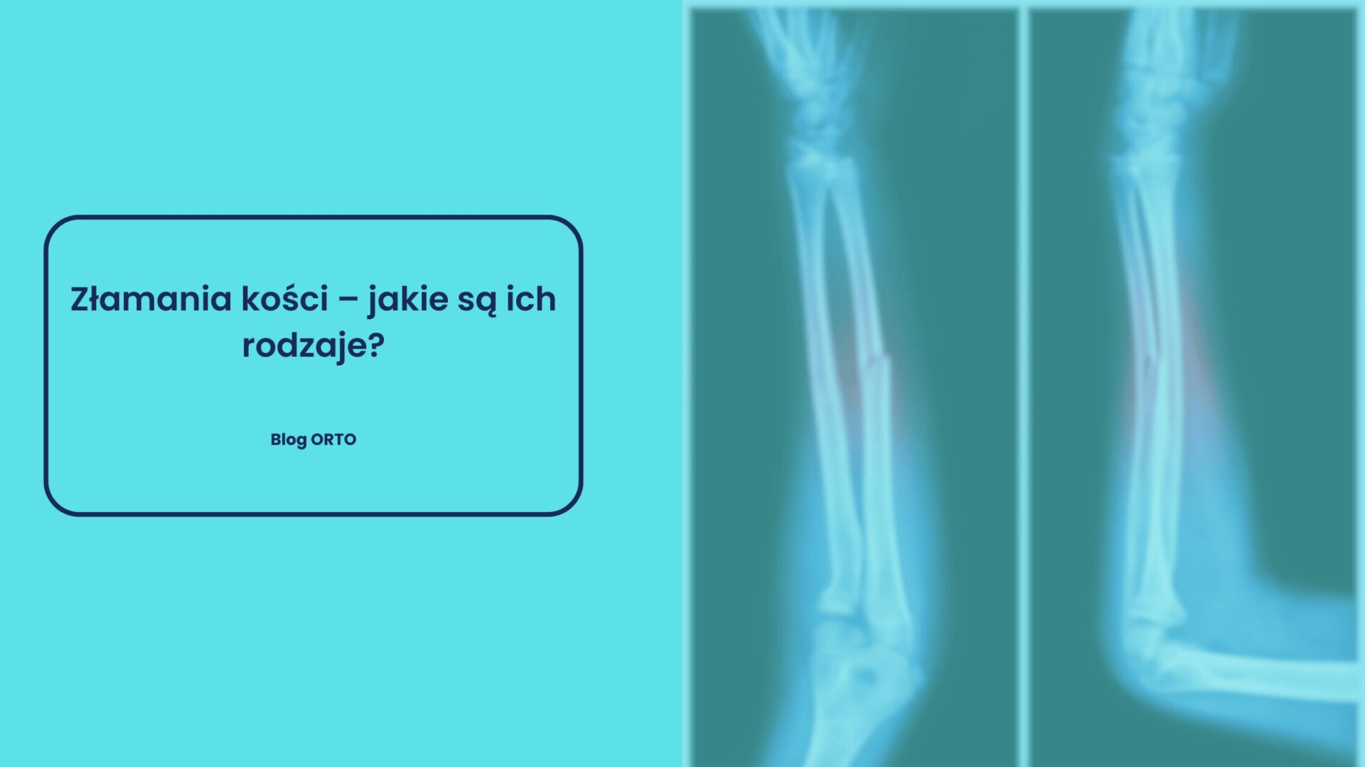 Złamania kości – jakie są ich rodzaje? - blog orto.pl