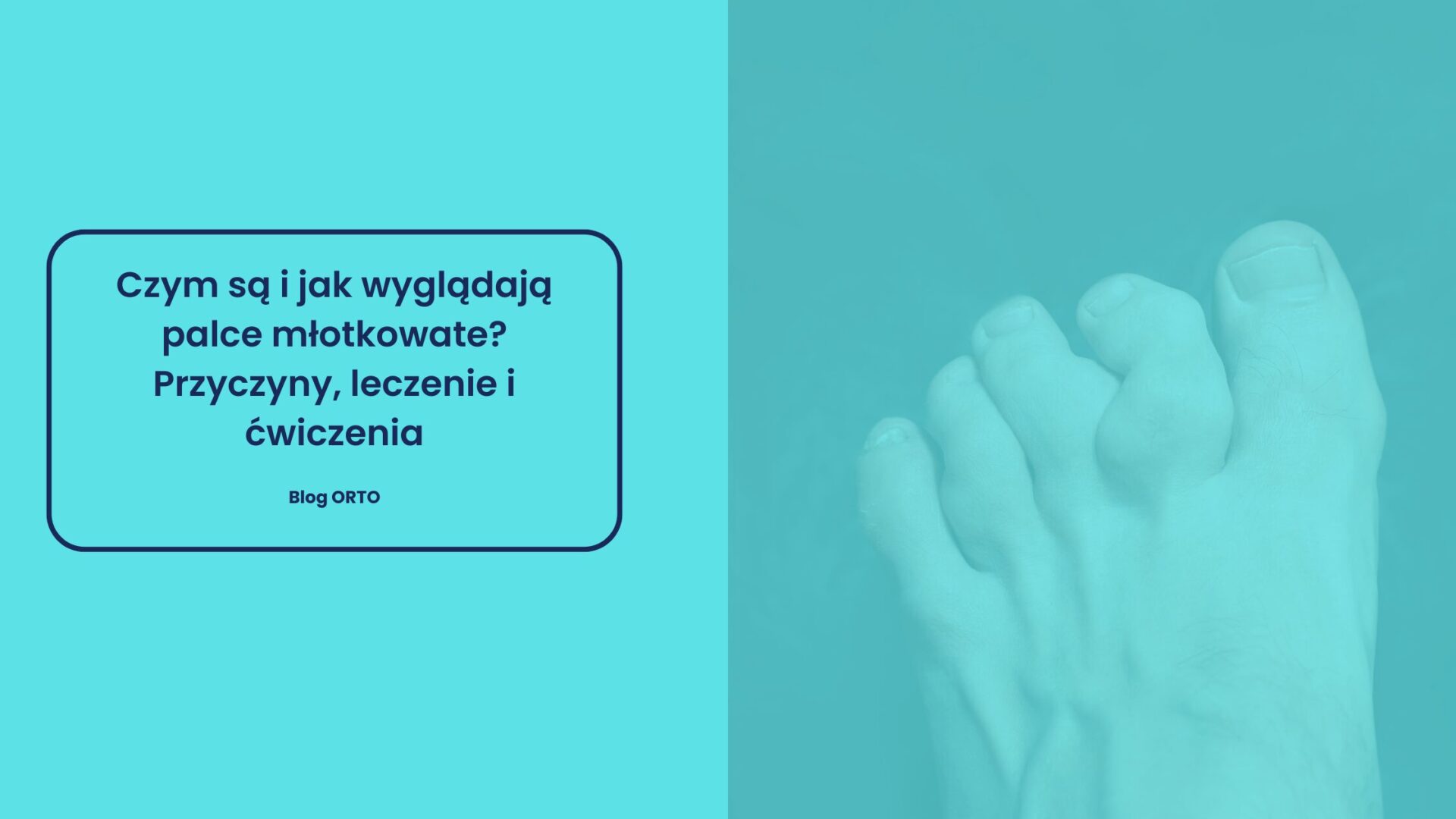 Czym są i jak wyglądają palce młotkowate? Przyczyny, leczenie i ćwiczenia | Blog orto.pl