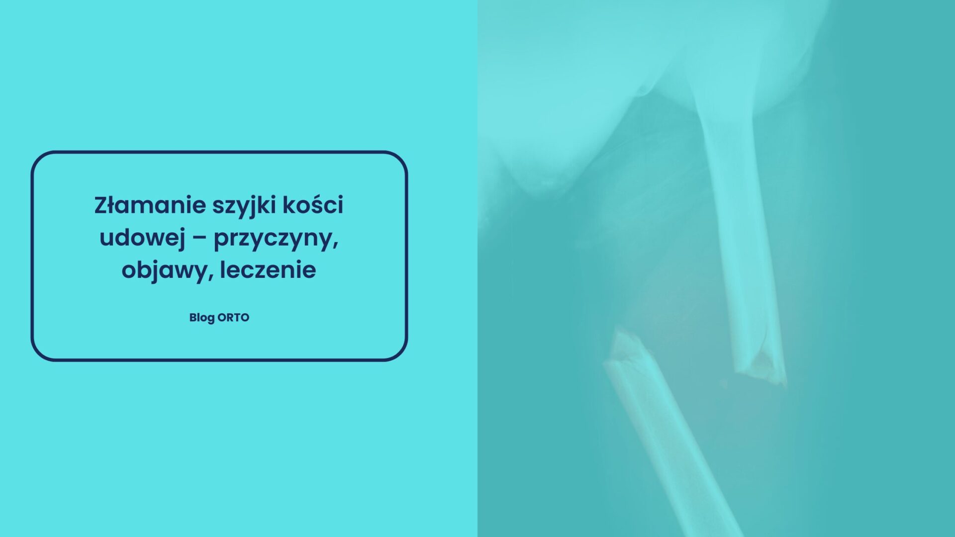 Złamanie szyjki kości udowej – przyczyny, objawy, leczenie